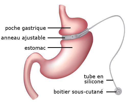 Anneau gastrique Tunisie