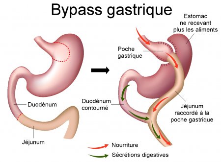 Bypass gastrique en Tunisie