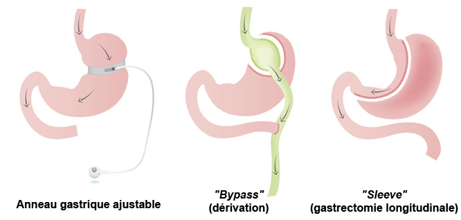 Traifs chirurgie obesite Tunisie